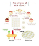 Acne Patches 20 pcs - MasksńMore