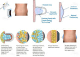 Cryolipolysis Fat Lipolysis Fat Freeze Machine - MasksńMore