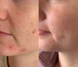 O’Melon Omega Green PDT Acne & Rosacea Treatment