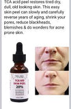 TCA Skin Peel Serum - 30ml - MasksńMore