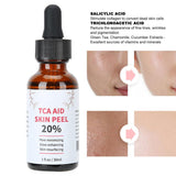 TCA Skin Peel Serum - 30ml - MasksńMore